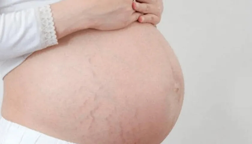 Stretch marks, also called striae distensae or striae gravidarum, look like indented streaks in your skin. They may be red, purple, or silver in appearance. Stretch marks most often appear on the:

stomach
chest
hips
bottom
thighs.

#pregnancystretchmarks #preventingpregnancystretchmarks #stretchmarks #stretchmarksremovalathome #fadestretchmarks #removestretchmarks #getridofstretchmarks #getridofstretchmarksfast #howtogetridofstretchmarksnaturally #gettingridofstretchmarks #howtogetridofstretchmarksfast